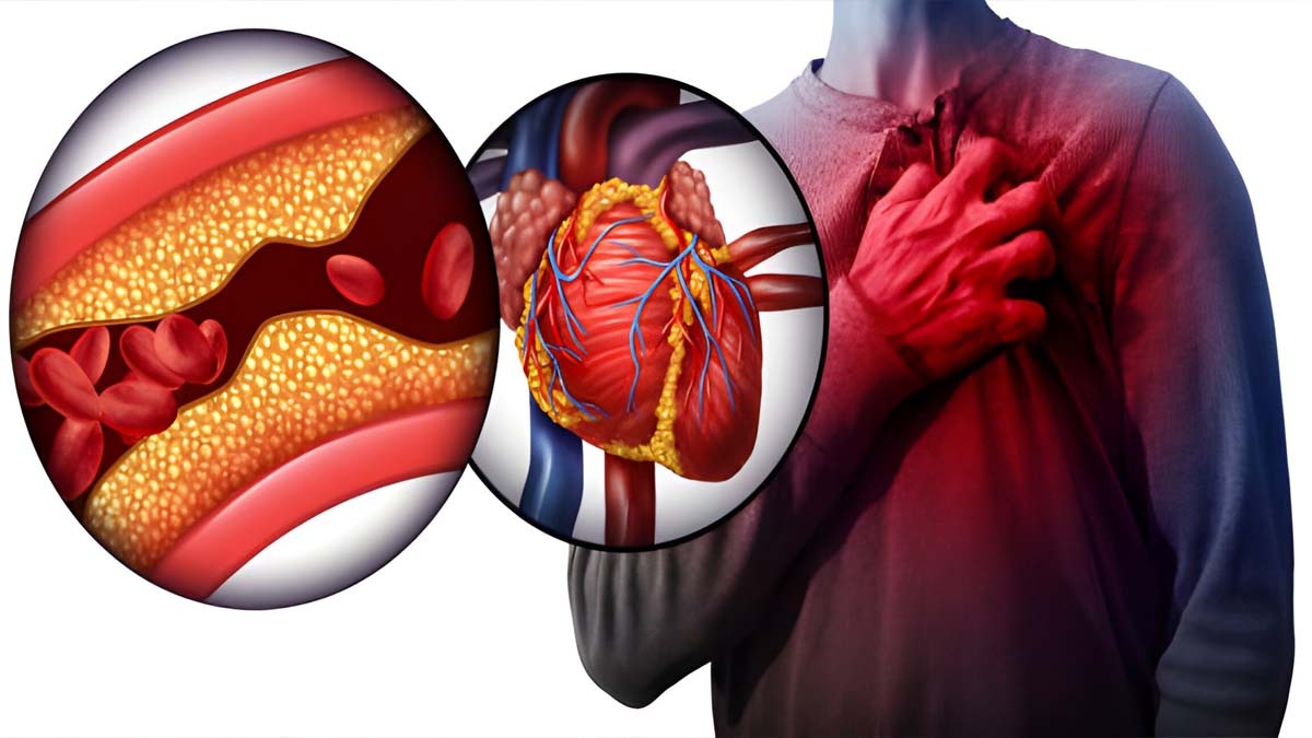heart bolckage
